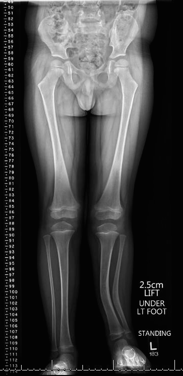 Posteromedial Bowing Of The Tibia | Pediatric Orthopaedic Society Of ...